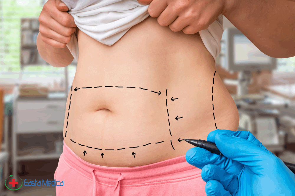Reasons you may consider Tummy Tuck Surgery after delivering Baby